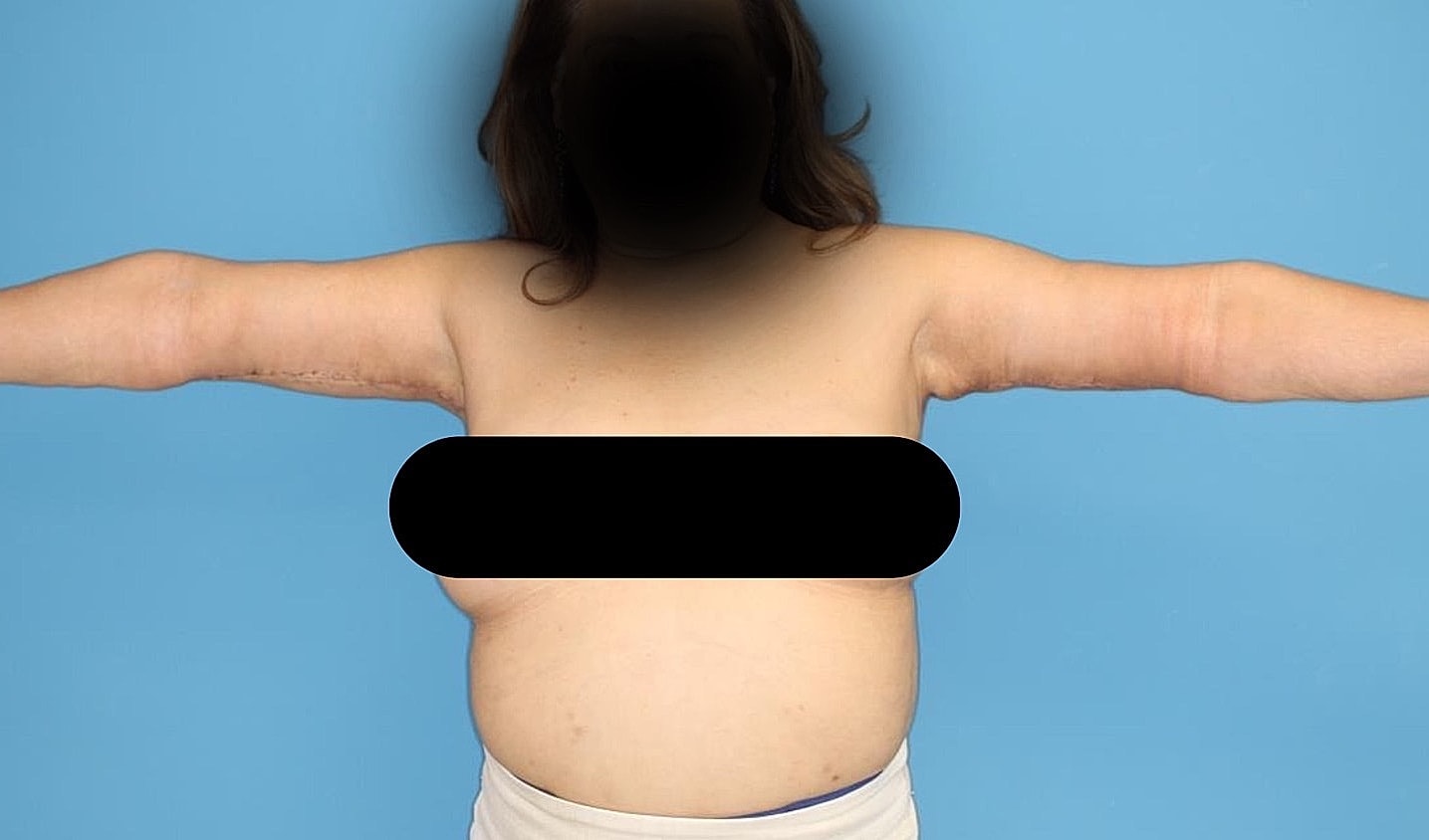Arm Lift Before & After