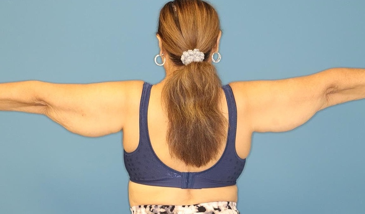 Arm Lift Before & After