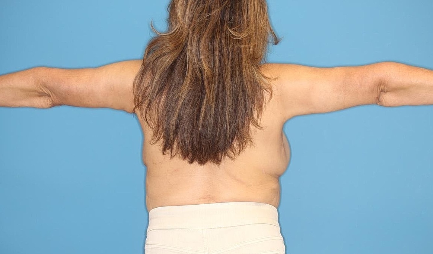 Arm Lift Before & After
