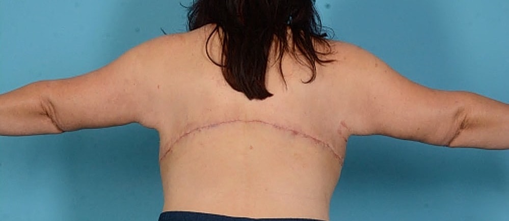 Arm Lift Before & After
