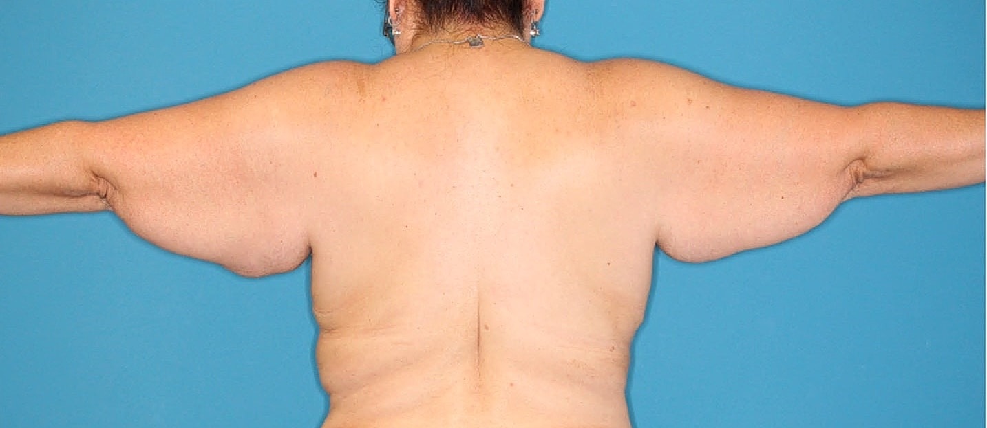 Arm Lift Before & After