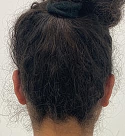 Otoplasty Before & After