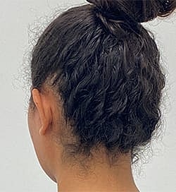 Otoplasty Before & After