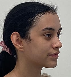 Otoplasty Before & After