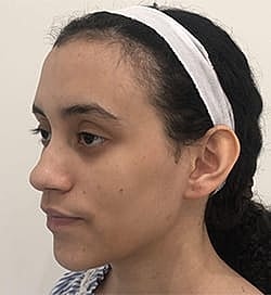 Otoplasty Before & After