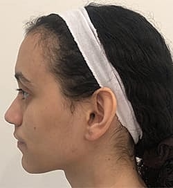 Otoplasty Before & After