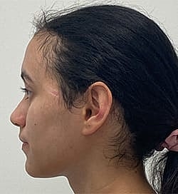 Otoplasty Before & After