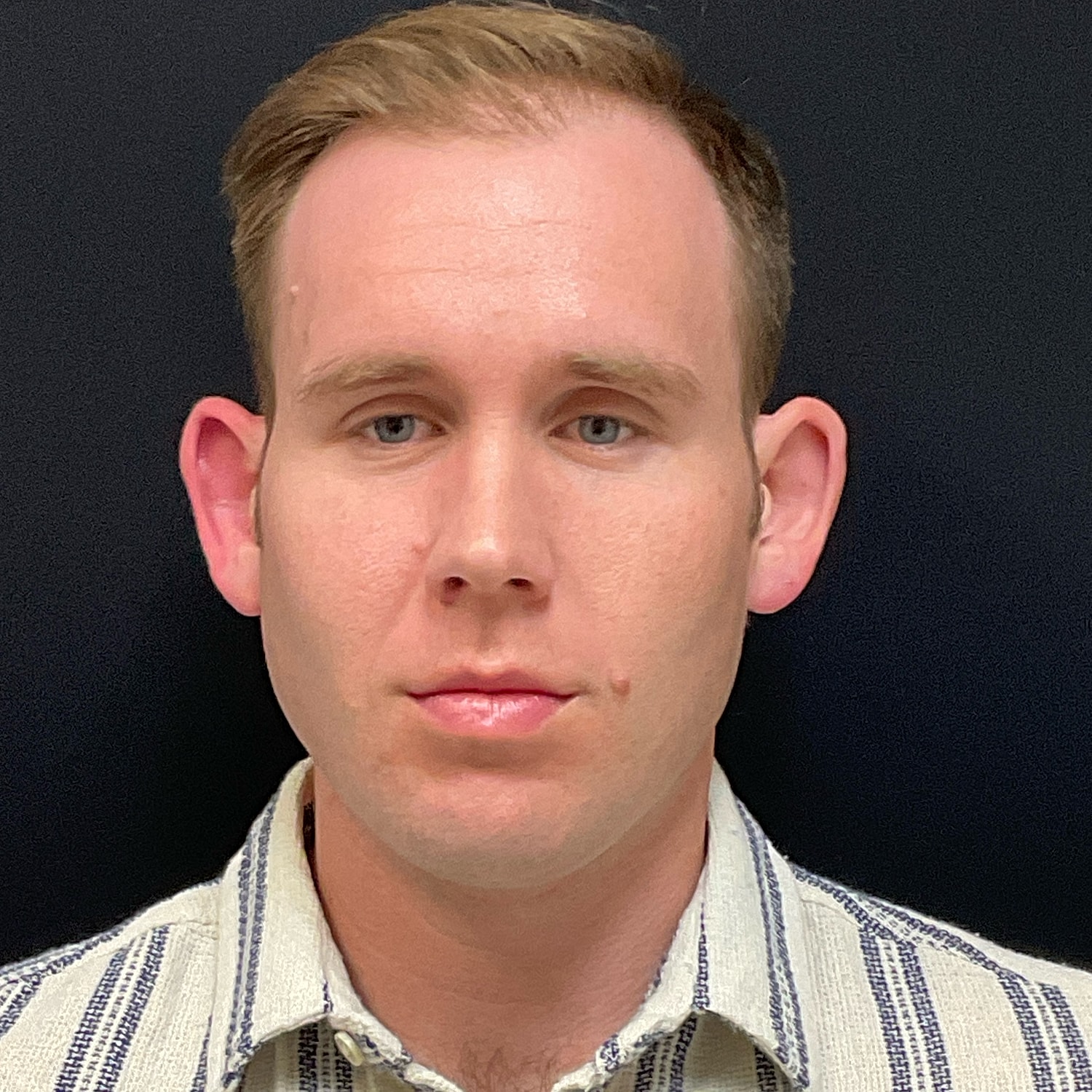 Otoplasty Before & After