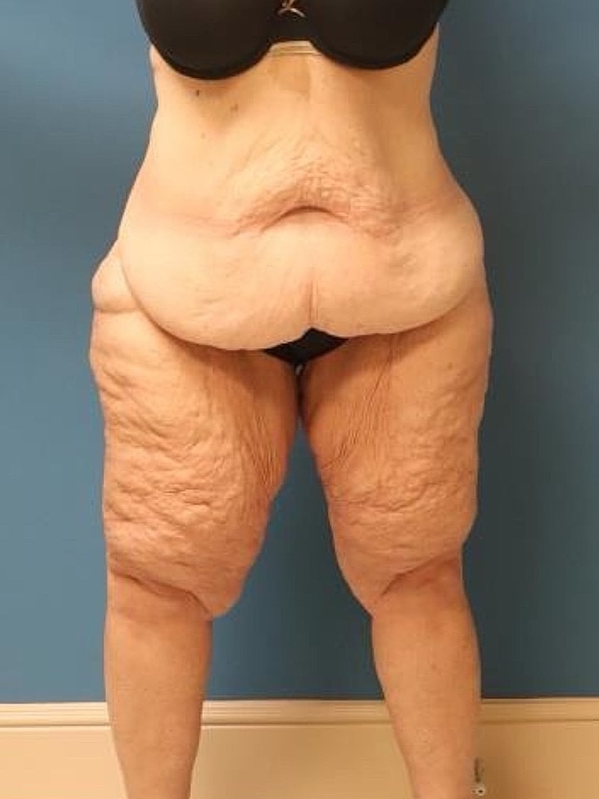 Thigh Lift Before & After