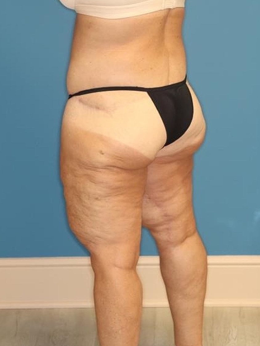 Thigh Lift Before & After