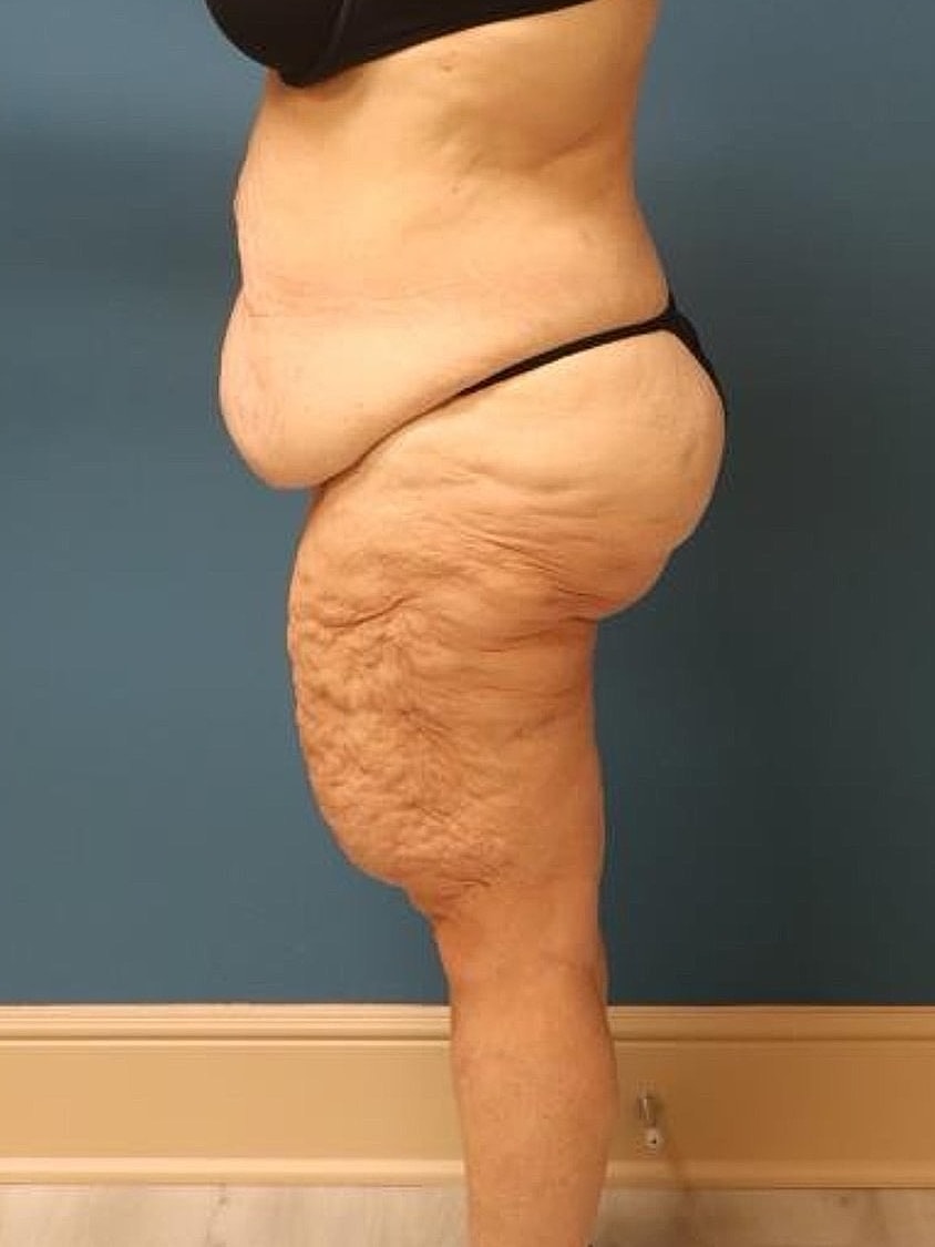 Thigh Lift Before & After