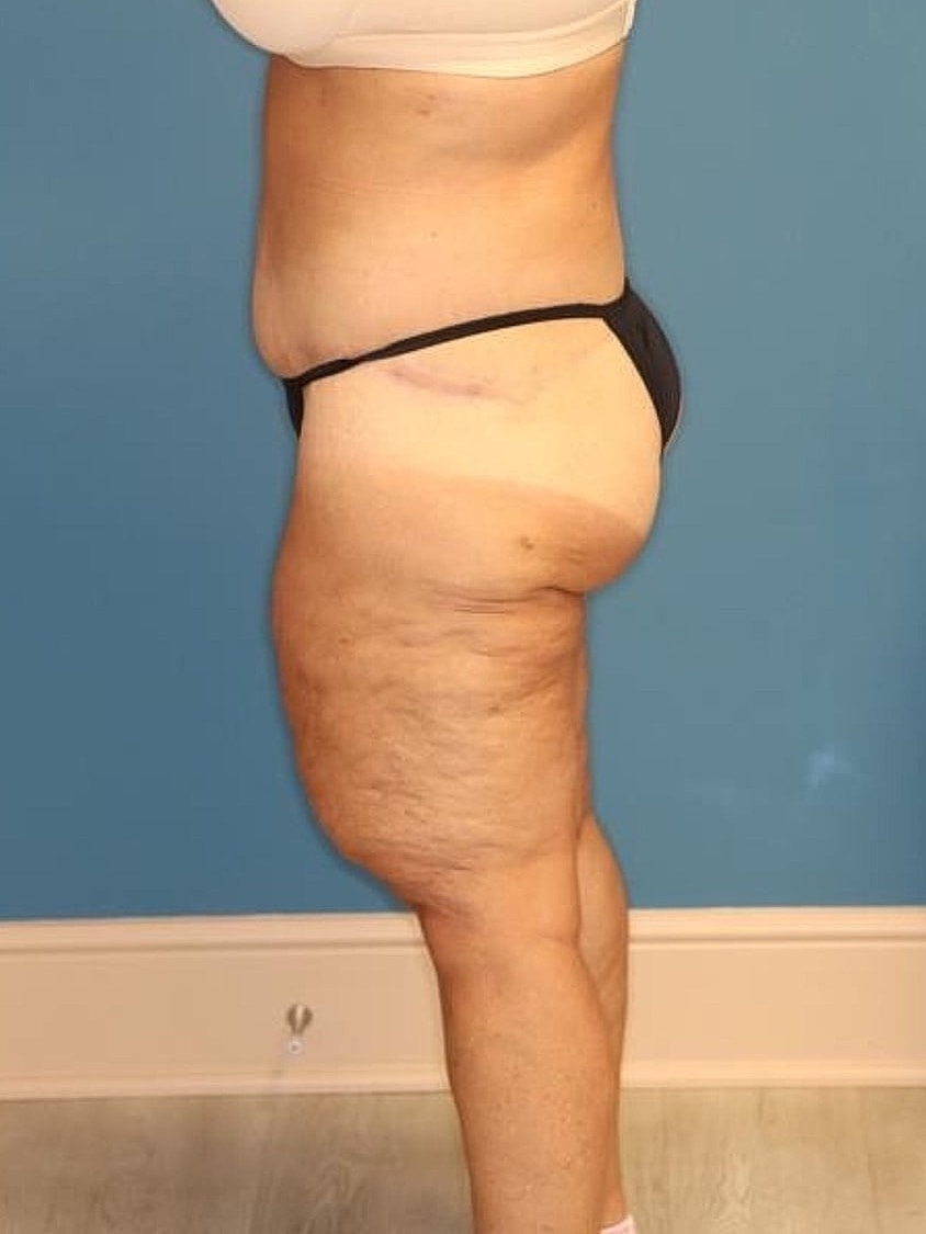 Thigh Lift Before & After