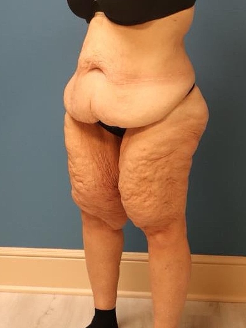 Thigh Lift Before & After
