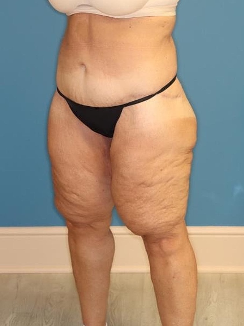 Thigh Lift Before & After