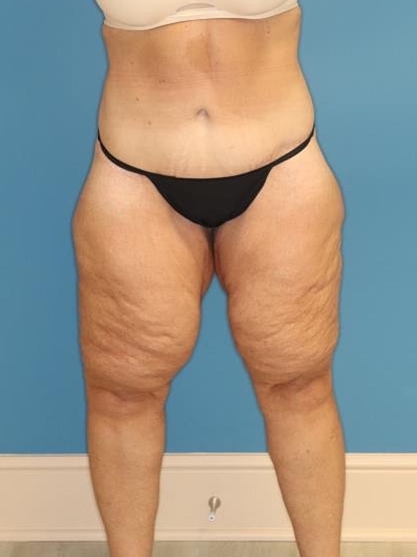 Thigh Lift Before & After