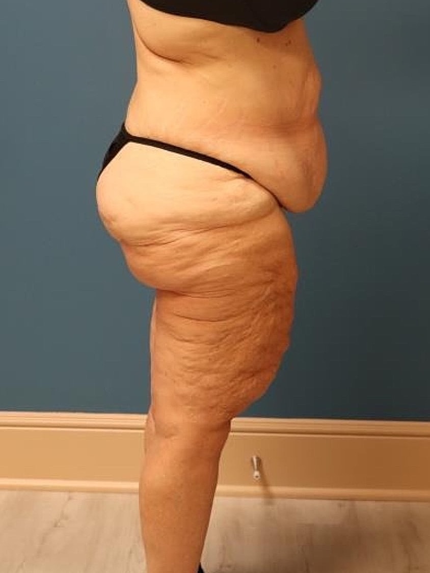Thigh Lift Before & After