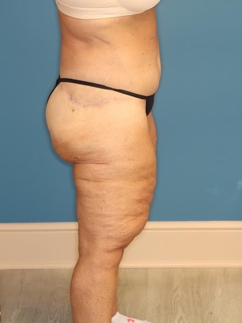 Thigh Lift Before & After