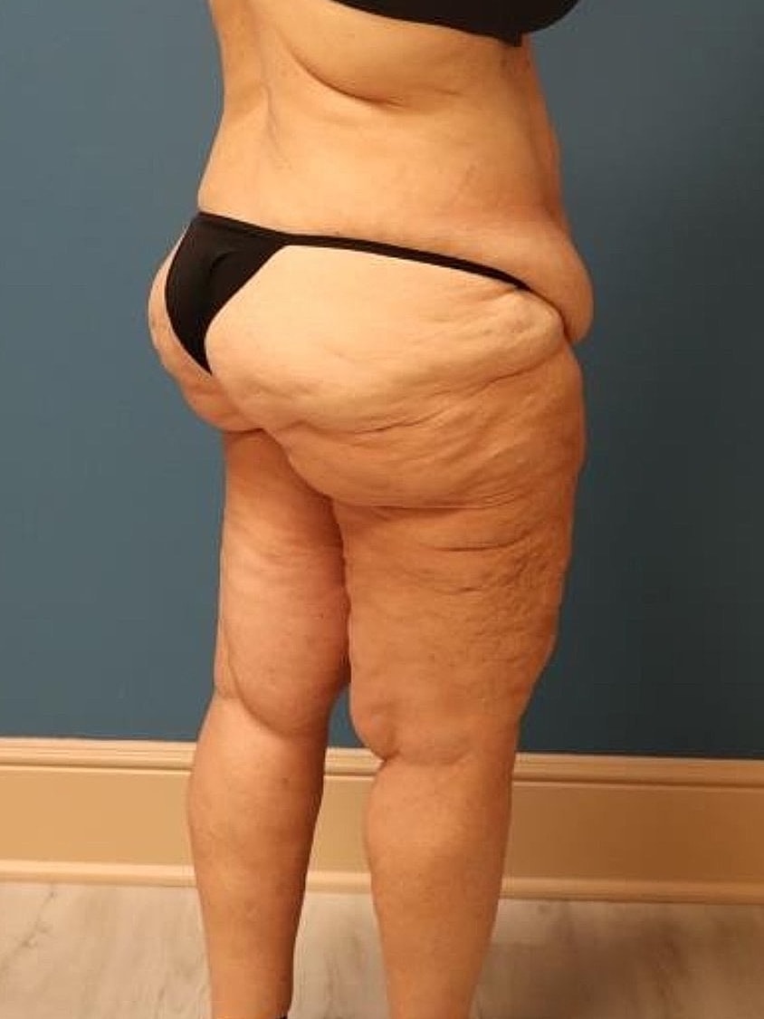 Thigh Lift Before & After