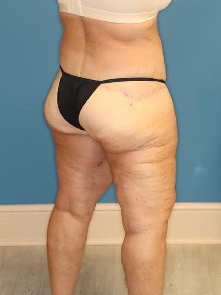 Thigh Lift Before & After