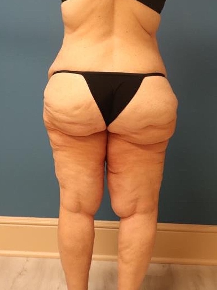 Thigh Lift Before & After