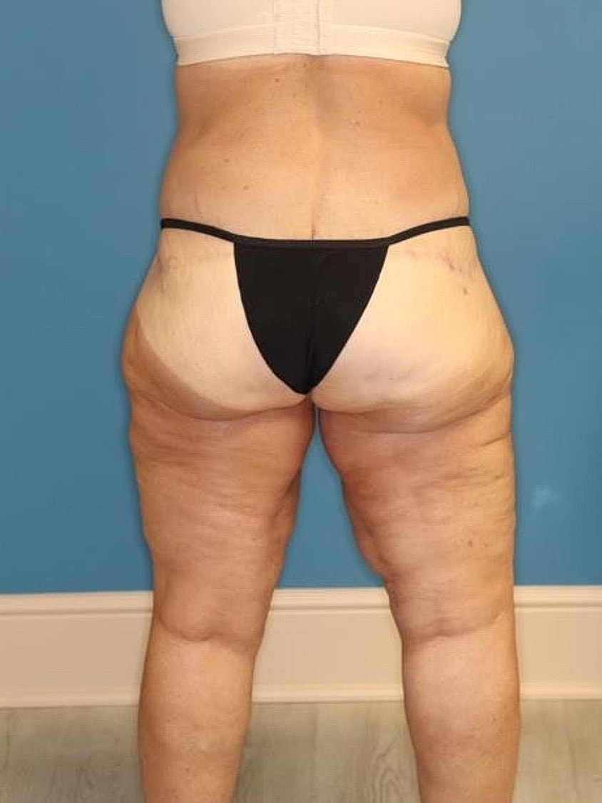 Thigh Lift Before & After
