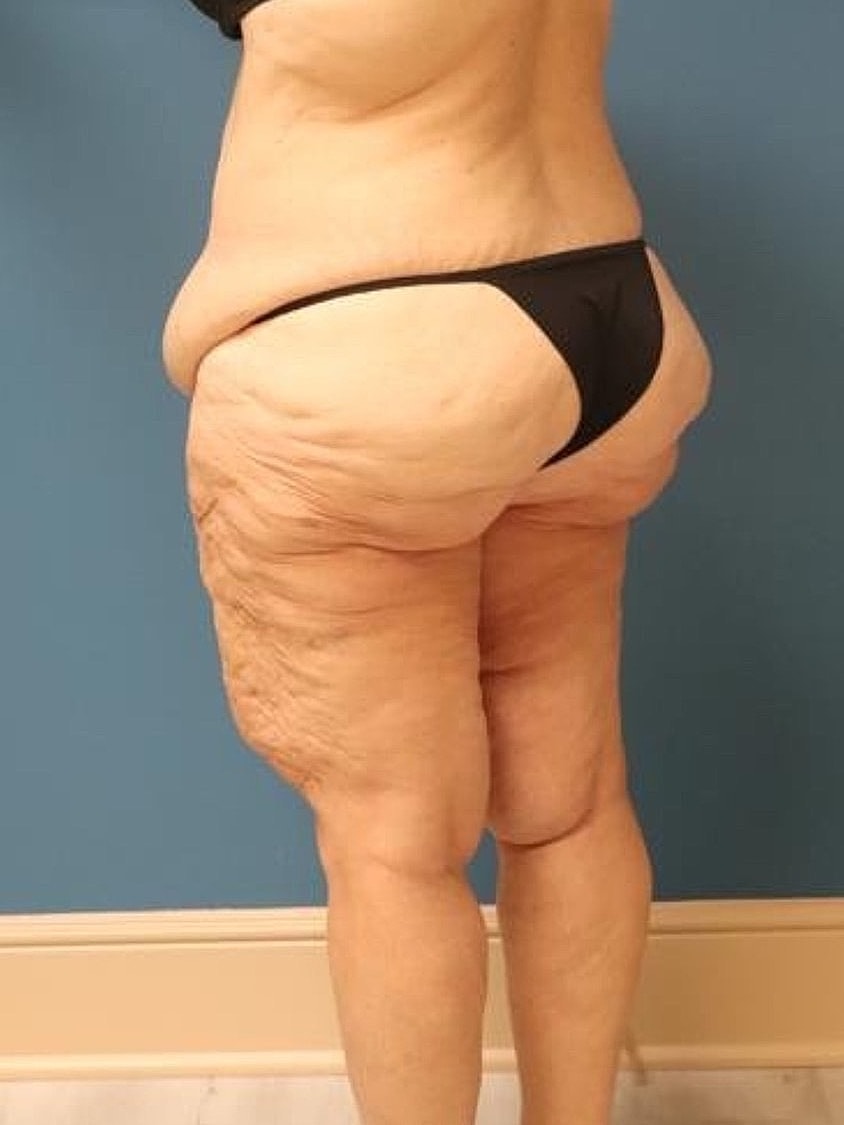 Thigh Lift Before & After
