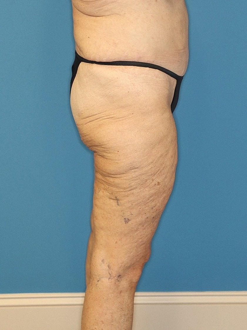 Thigh Lift Before & After