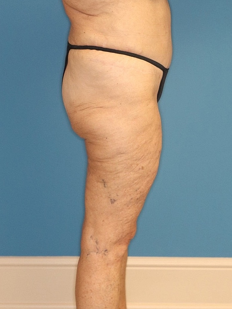 Thigh Lift Before & After