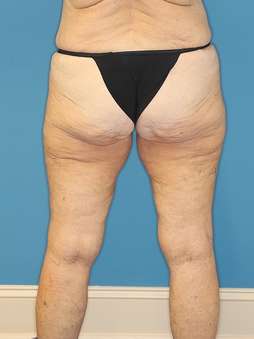 Thigh Lift Before & After