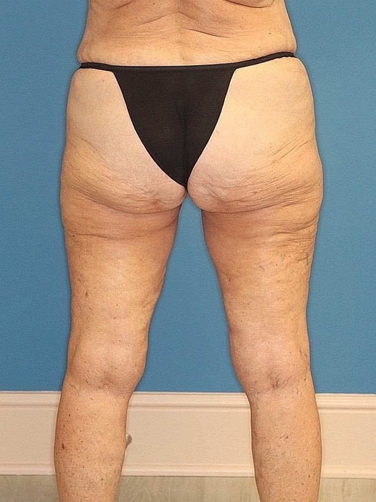 Thigh Lift Before & After
