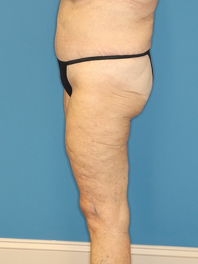 Thigh Lift Before & After