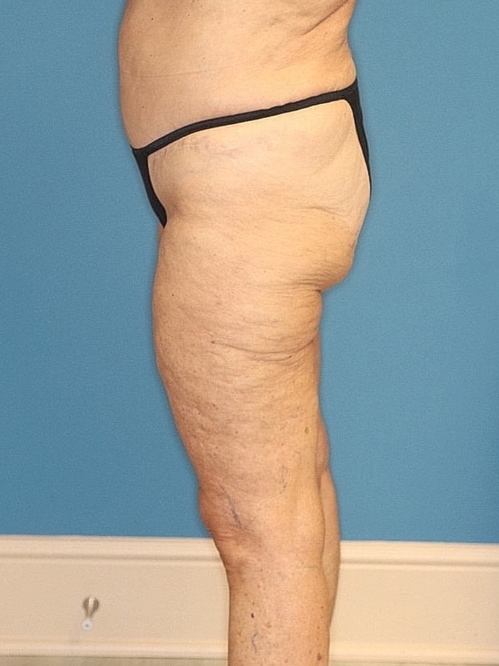 Thigh Lift Before & After