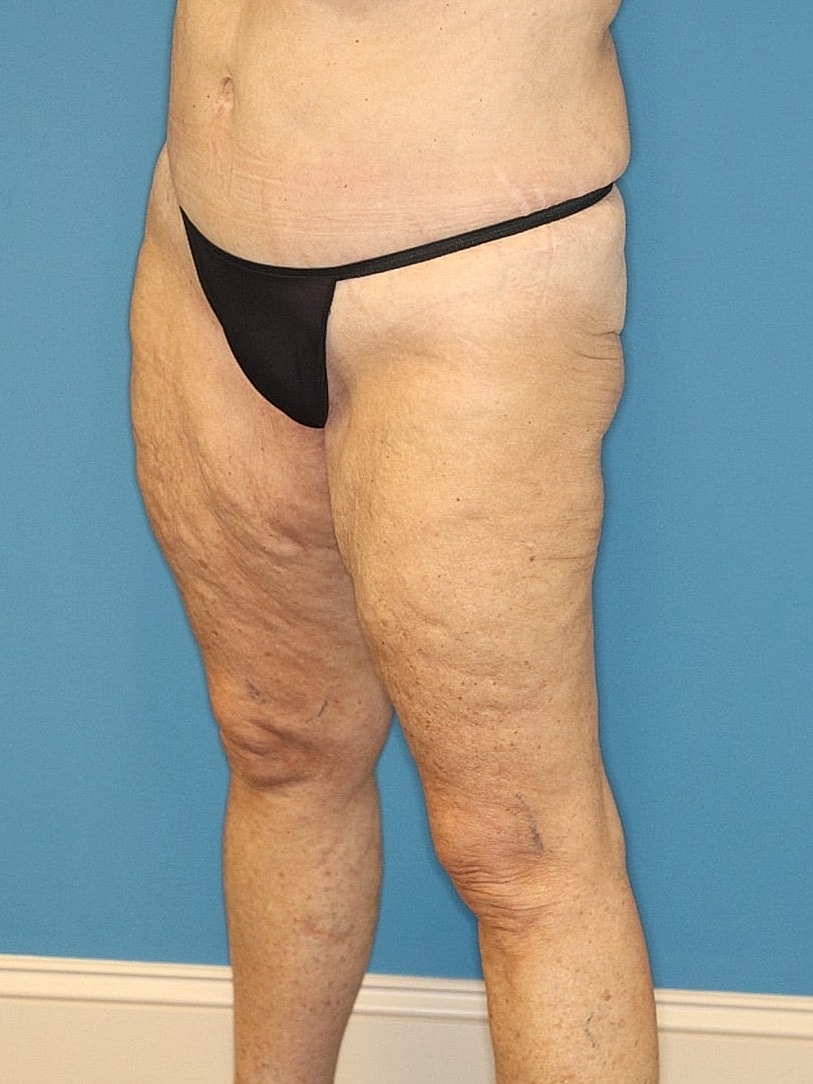 Thigh Lift Before & After