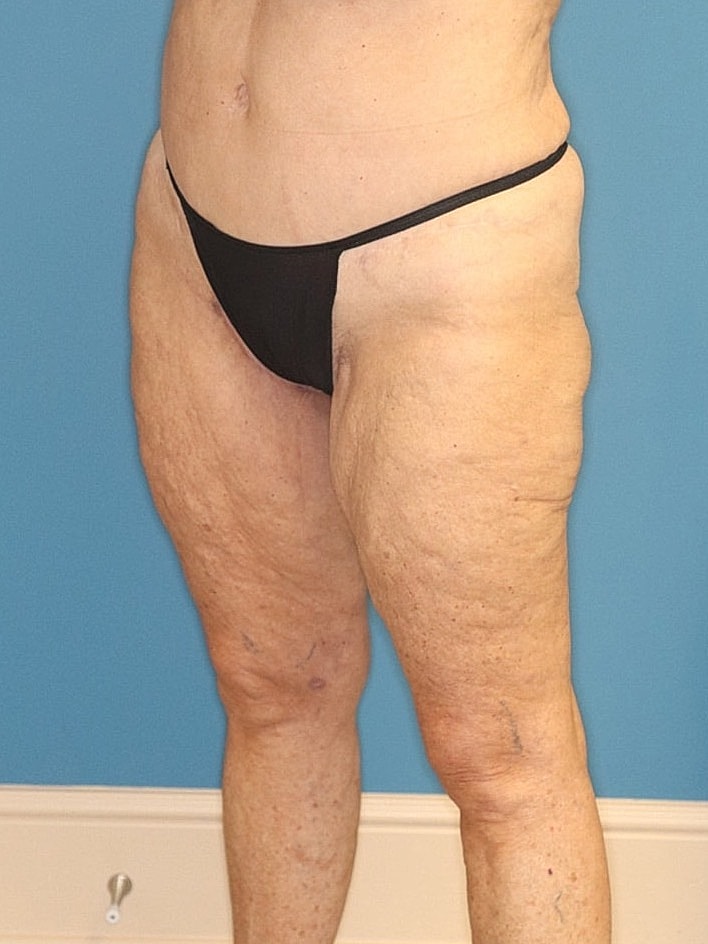 Thigh Lift Before & After