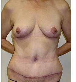 Mommy Makeover Before & After