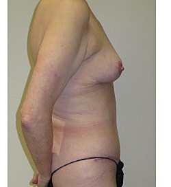 Mommy Makeover Before & After