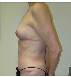 Mommy Makeover Before & After