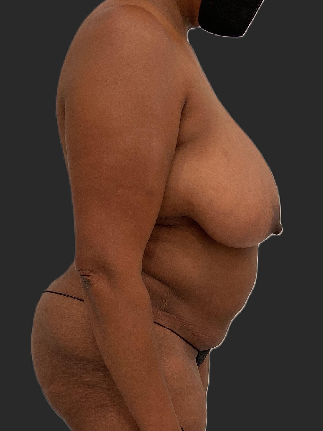 Mommy Makeover Before & After