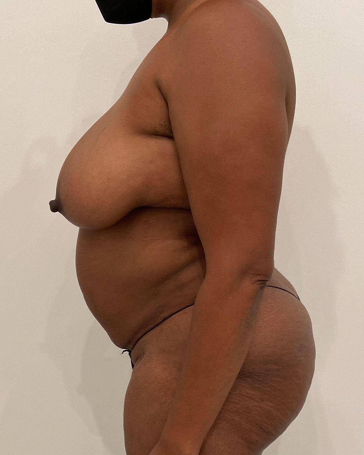 Mommy Makeover Before & After