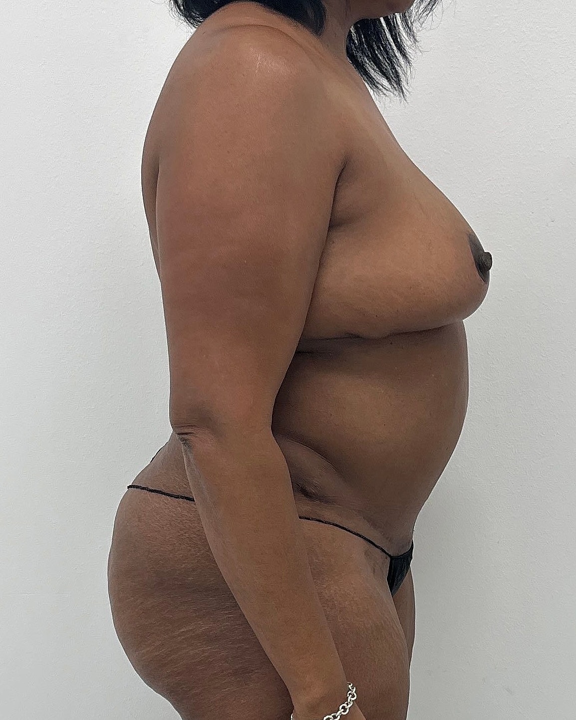 Mommy Makeover Before & After