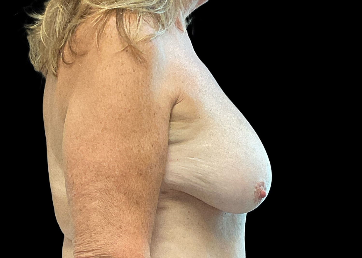 Breast Lift With Implant Before & After