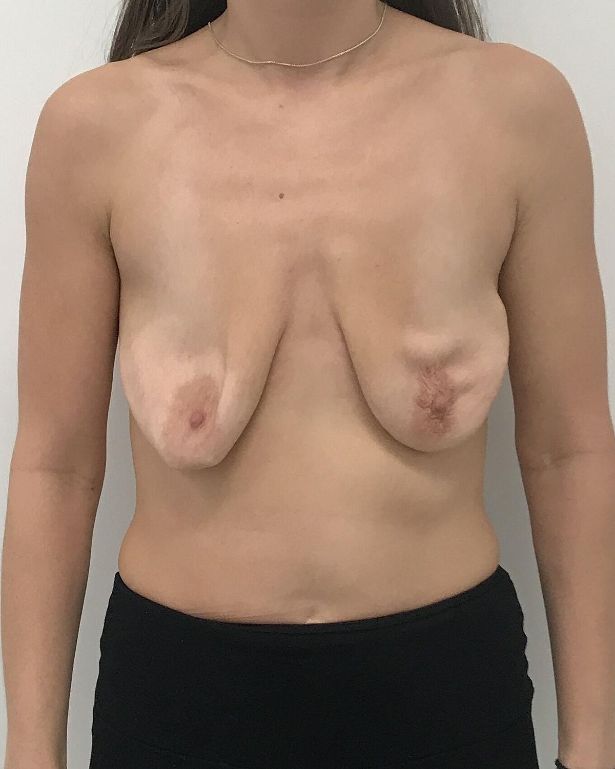 Breast Lift With Implant Before & After