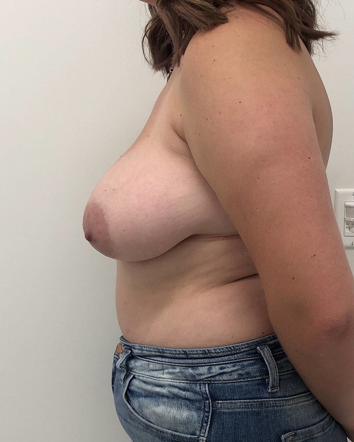 Breast Lift With Implant Before & After