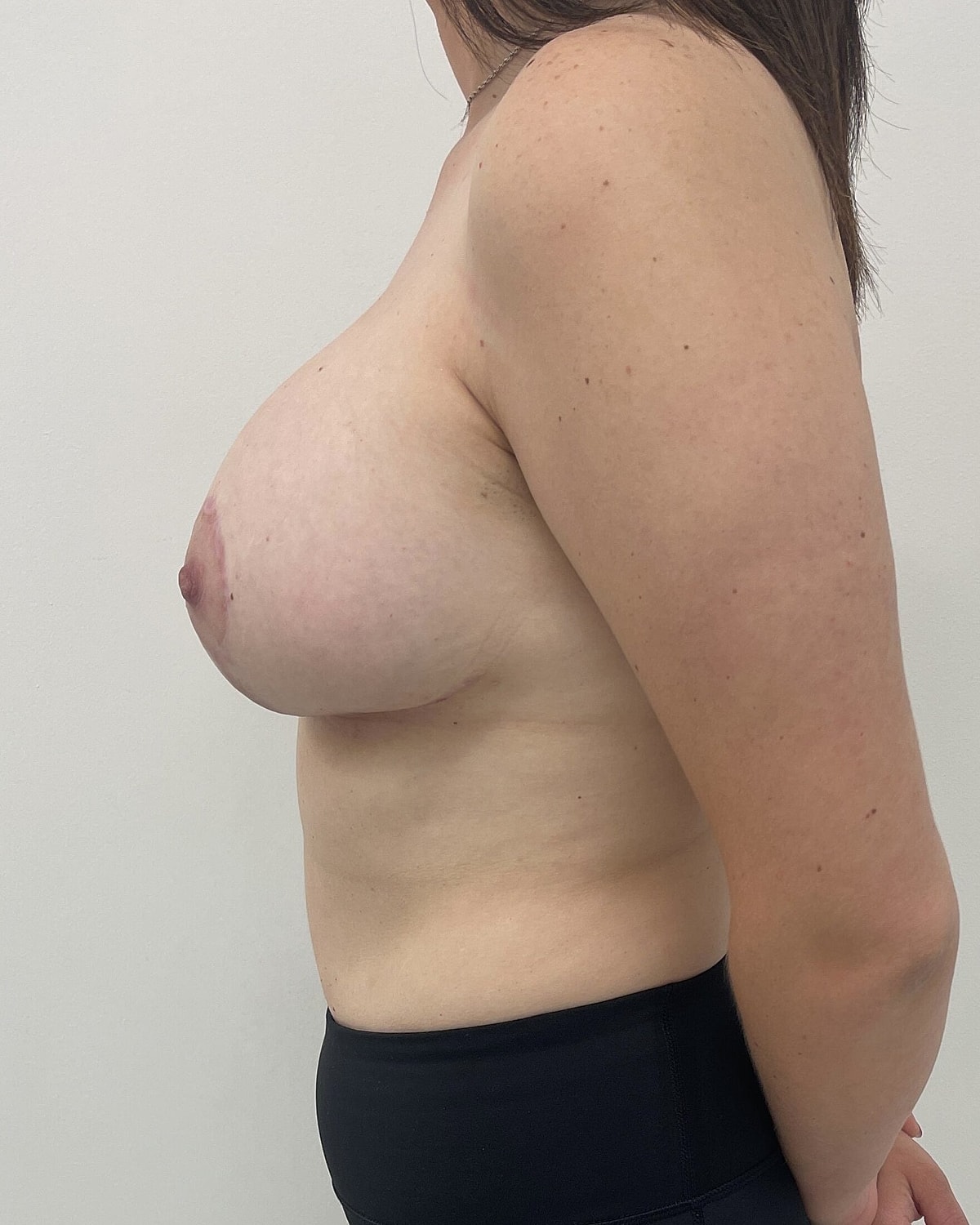 Breast Lift With Implant Before & After