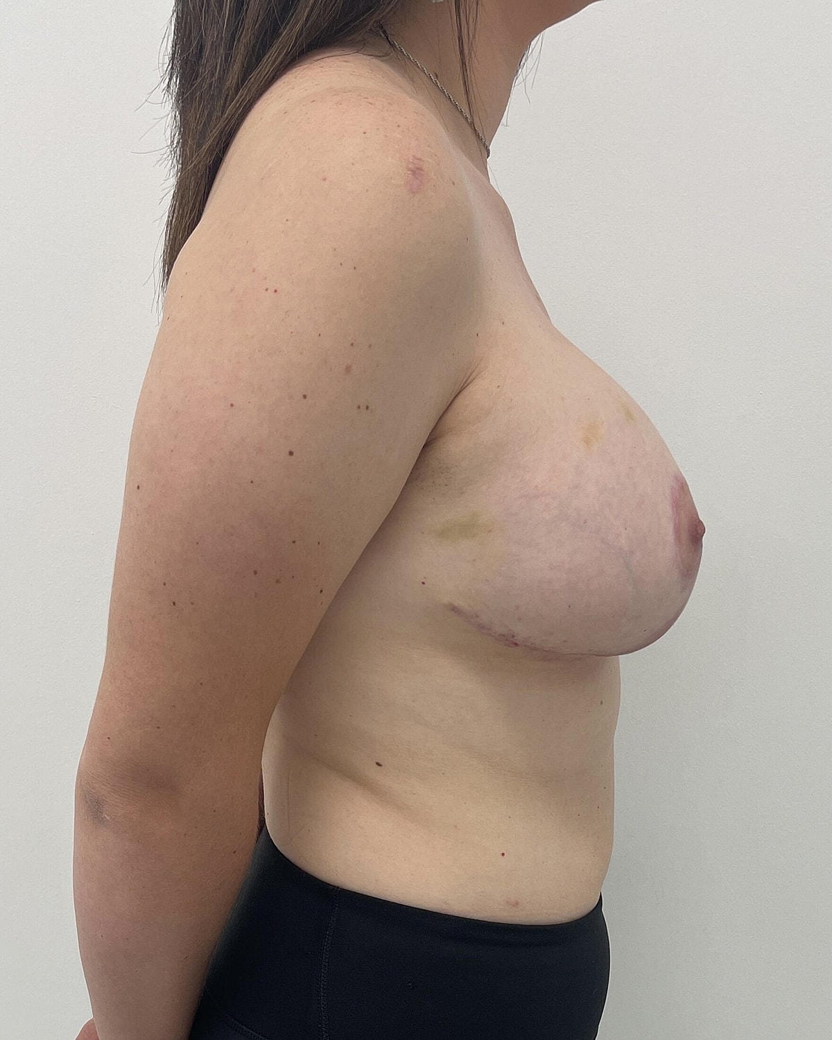 Breast Lift With Implant Before & After