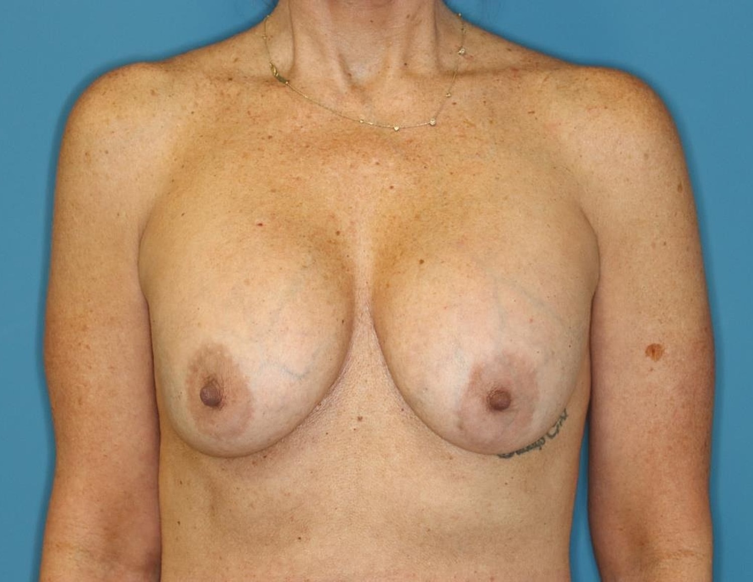 Breast Lift With Implant Before & After