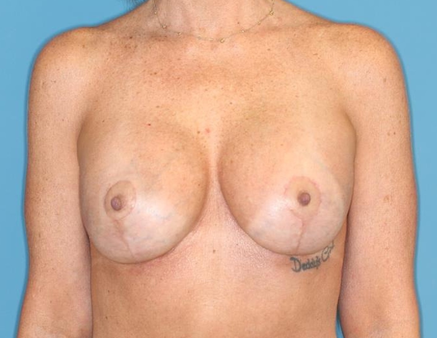 Breast Lift With Implant Before & After