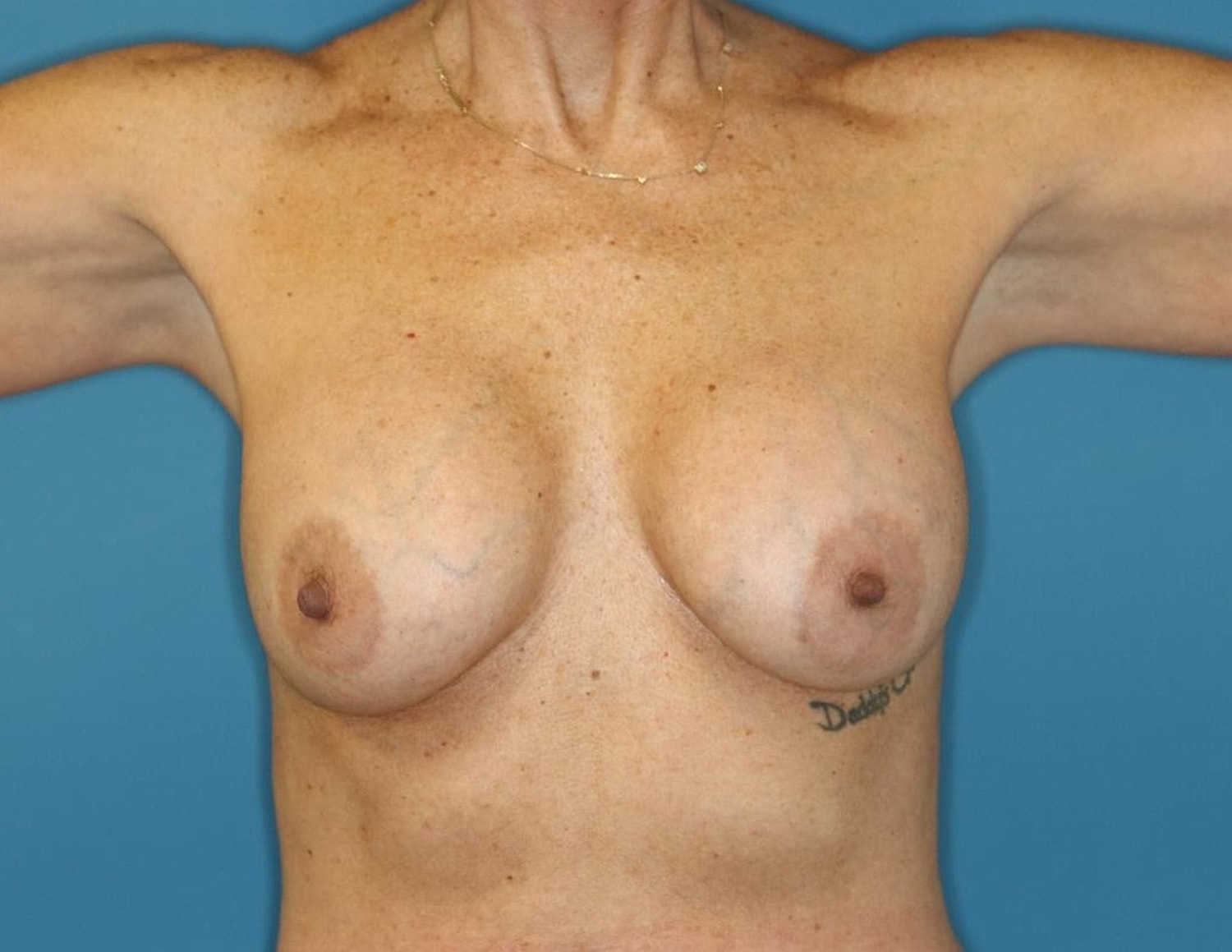 Breast Lift With Implant Before & After