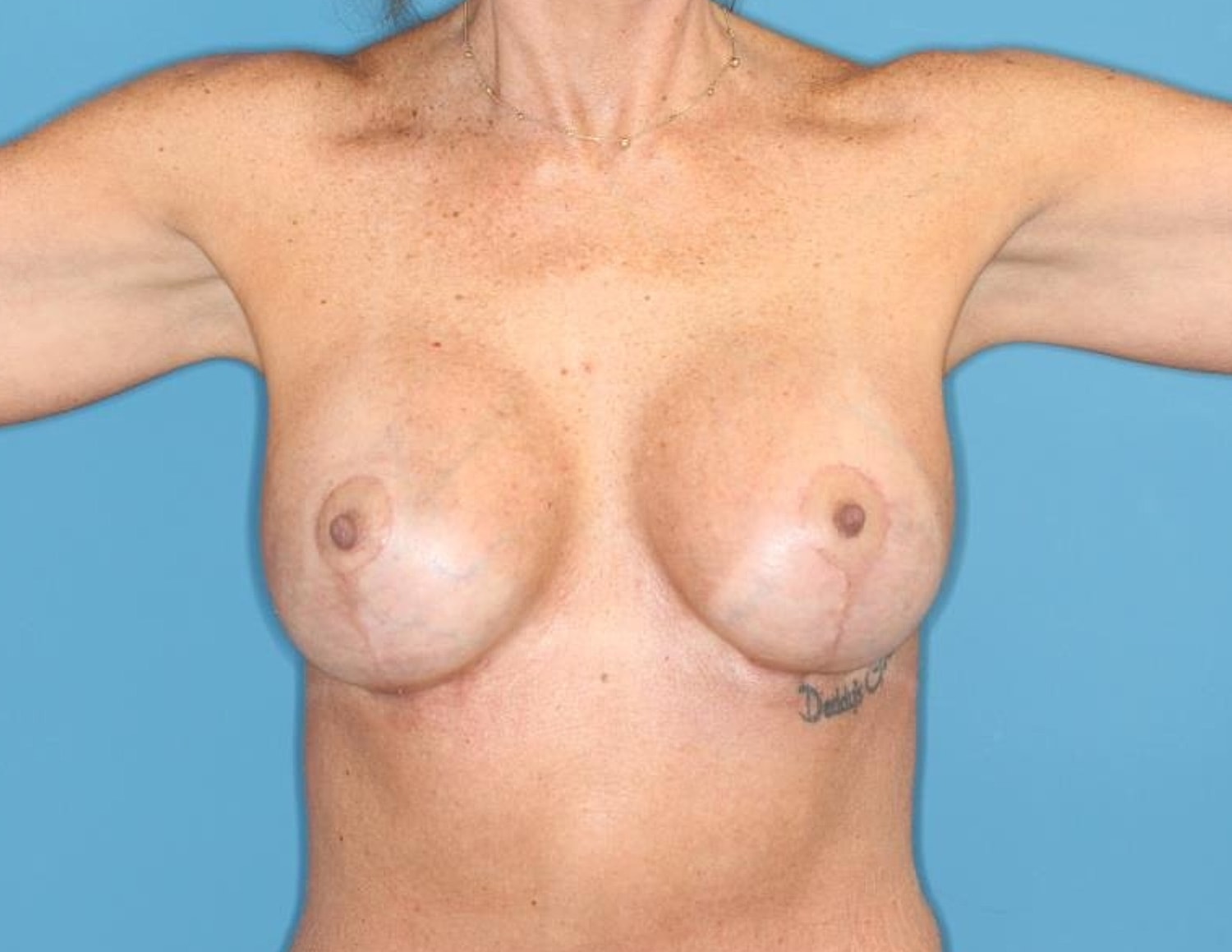 Breast Lift With Implant Before & After