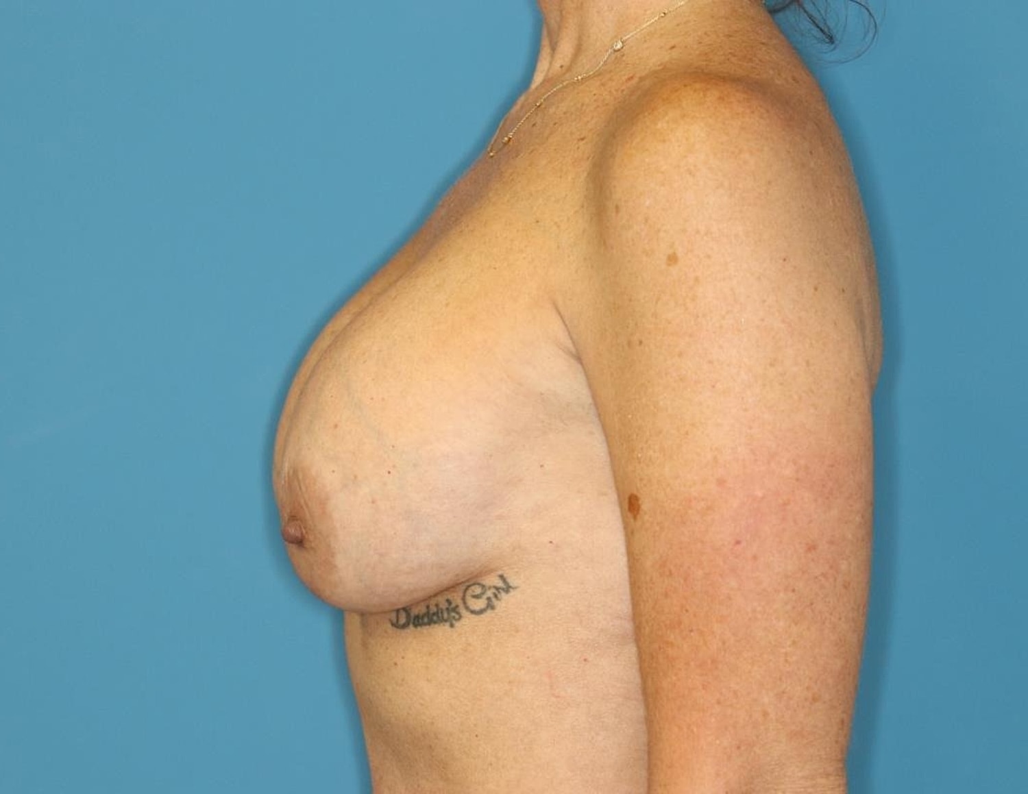 Breast Lift With Implant Before & After